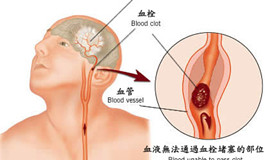紅葡萄酒可以有效預防中風后腦損傷